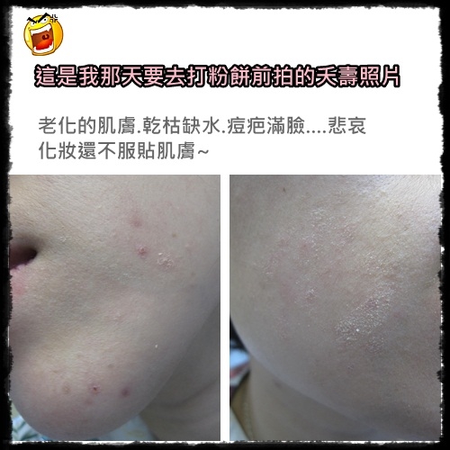 我終於變白了~~~粉餅雷射