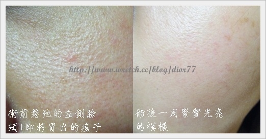 【雷射美容】光纖+淨膚雷射初體驗之術前、術後一周紀錄(下)