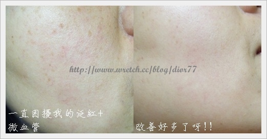 【雷射美容】光纖+淨膚雷射初體驗之術前、術後一周紀錄(下)