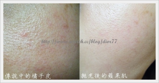 【雷射美容】光纖+淨膚雷射初體驗之術前、術後一周紀錄(下)