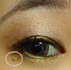 肉芽大概要打个3~5下吧 (痛到有点忘记) 还有就是我脸上有一块凸凸的