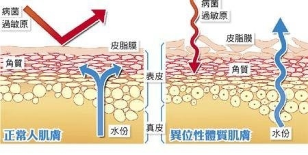 異位性皮膚炎?猛擦藥?保溼很重要!