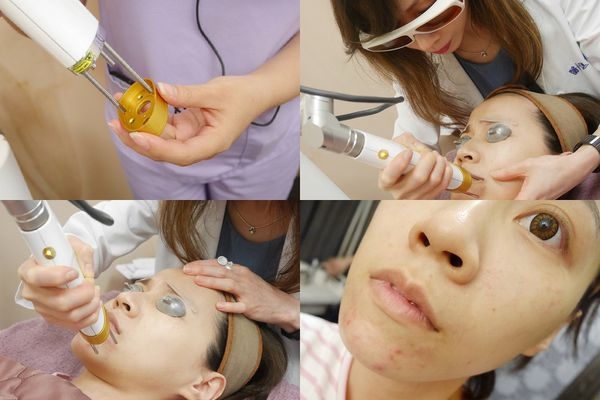 [医美]跟斑点,粗糙say byebye,超美诊所 picoq皮秒雷射初体验 在过程