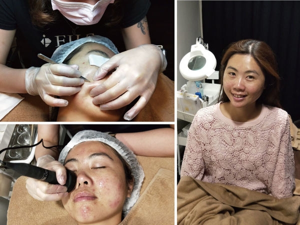 【台南美容】FILF小資美顏館|消除粉刺林,拯救蠟黃肌|重返20歲|親民價格也有超值效果
