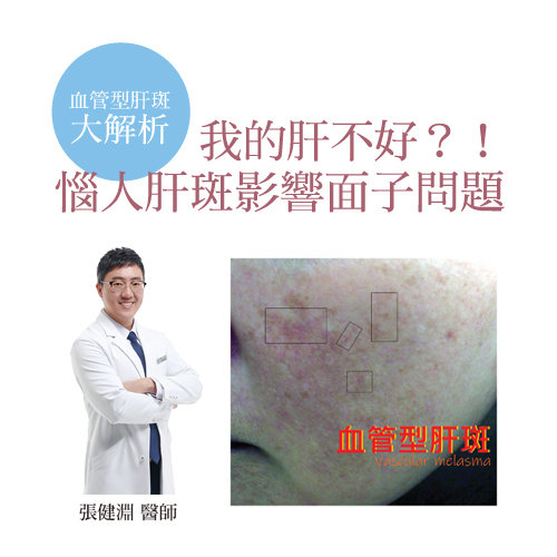 我的肝不好?!惱人肝斑影響面子問題
