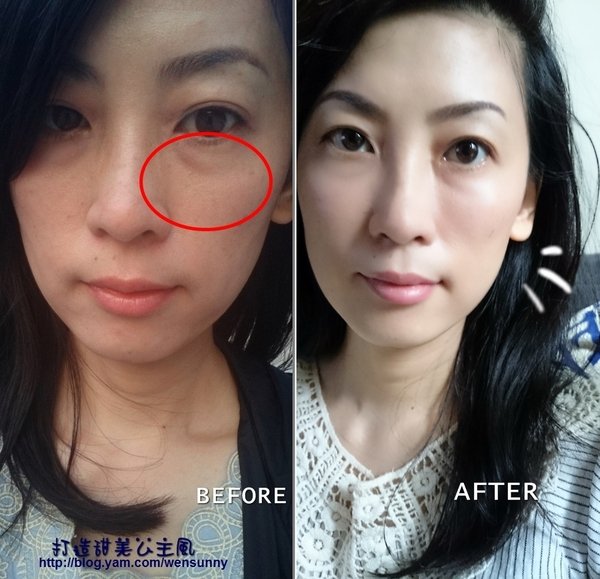 醫美 我要擁有蘋果肌 消除淚溝打造甜美princess公主風 星采醫美診所 古亭 玻尿酸醫美療程初體驗 保鮮美人部落格
