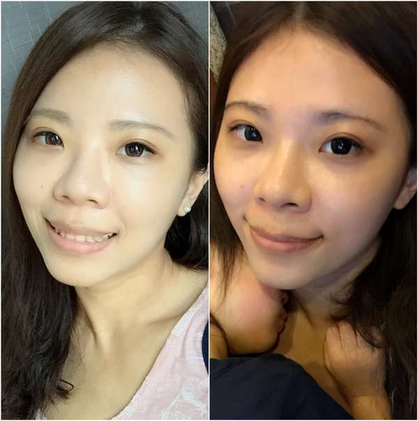 只要小小微調五官變立體了 ✿ DR.SHINE 光澤診所 ✿