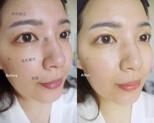 搶救熬夜肌,毛孔粗大、老化乾燥、暗沉蠟黃 OUT - 薇風三分子玻尿酸精華補水面膜 (大水滴面膜)